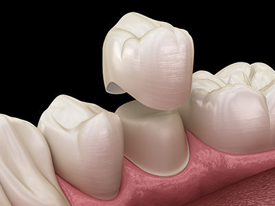 A digital rendering of a dental implant in the process of being placed, showing a close-up view of the titanium screw and abutment.