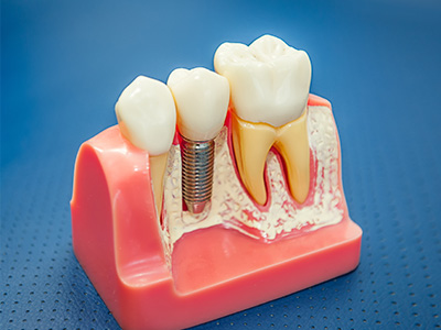 The image shows a dental model with teeth and gums, featuring a drill hole in the tooth enamel.