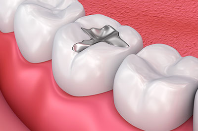 The image shows a close-up view of a dental implant fixture inserted into the bone of an upper jaw, with surrounding teeth and gum tissue.