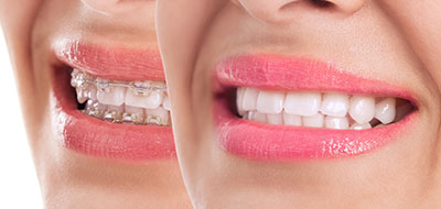 The image features a woman displaying her smile, with two different facial expressions captured in the same photograph.