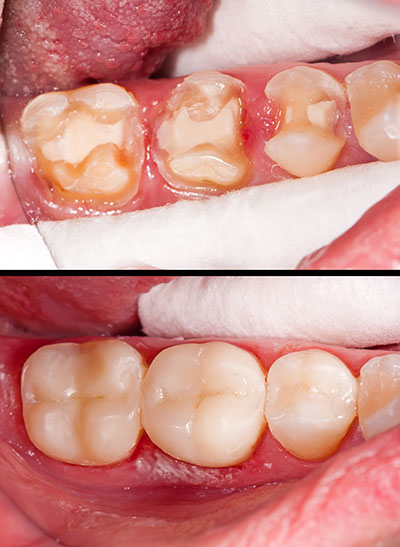 A close-up image of a person s mouth with teeth showing signs of decay and gum disease, illustrating the before and after stages of dental treatment.