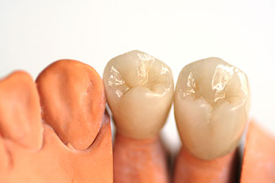 A side-by-side comparison of a human tooth and its corresponding dental implant model, both set against a white background.