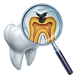 An illustration of a magnified tooth with an open crown, showcasing the internal structure and dental pulp, viewed through a magnifying glass.