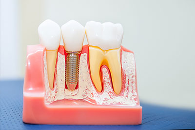 A dental model with teeth and gum, featuring a visible screw or implant.