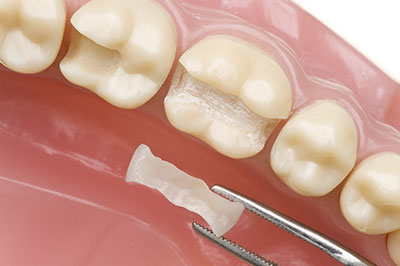 The image shows a close-up of a dental implant being inserted into a tooth socket, with the surrounding teeth and gums visible.