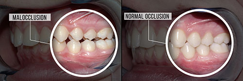 Before and after image of a mouth with teeth removed, showing the transformation from normal occlusion to malocclusion.