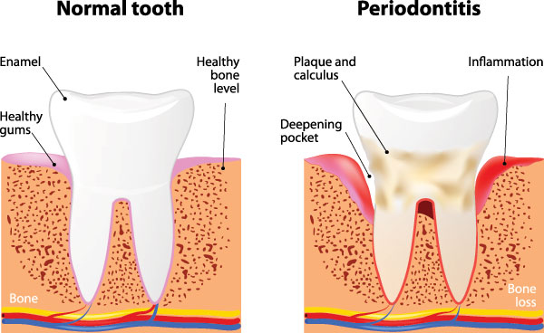 The image is a medical illustration showing the normal and affected states of teeth, with annotations explaining the differences between healthy and gum disease-affected teeth, highlighting symptoms such as bone loss, inflammation, and tooth decay.