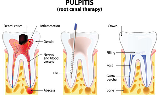 The image is a medical illustration showing a cross-sectional view of a tooth with pulpitis, highlighting inflammation and infection within the dental pulp.