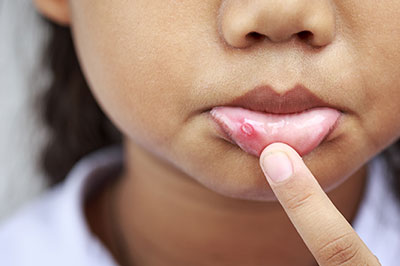 The image shows a close-up of a young person with their finger on their lips, and there appears to be some sort of skin condition or irritation visible on the lower lip area.