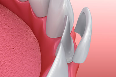 The image shows a close-up of a dental implant with a metal abutment and a pink gumline, set against a medical background.