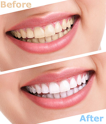 The image shows a smiling woman with teeth before and after cosmetic dental treatment, highlighting the transformation achieved.