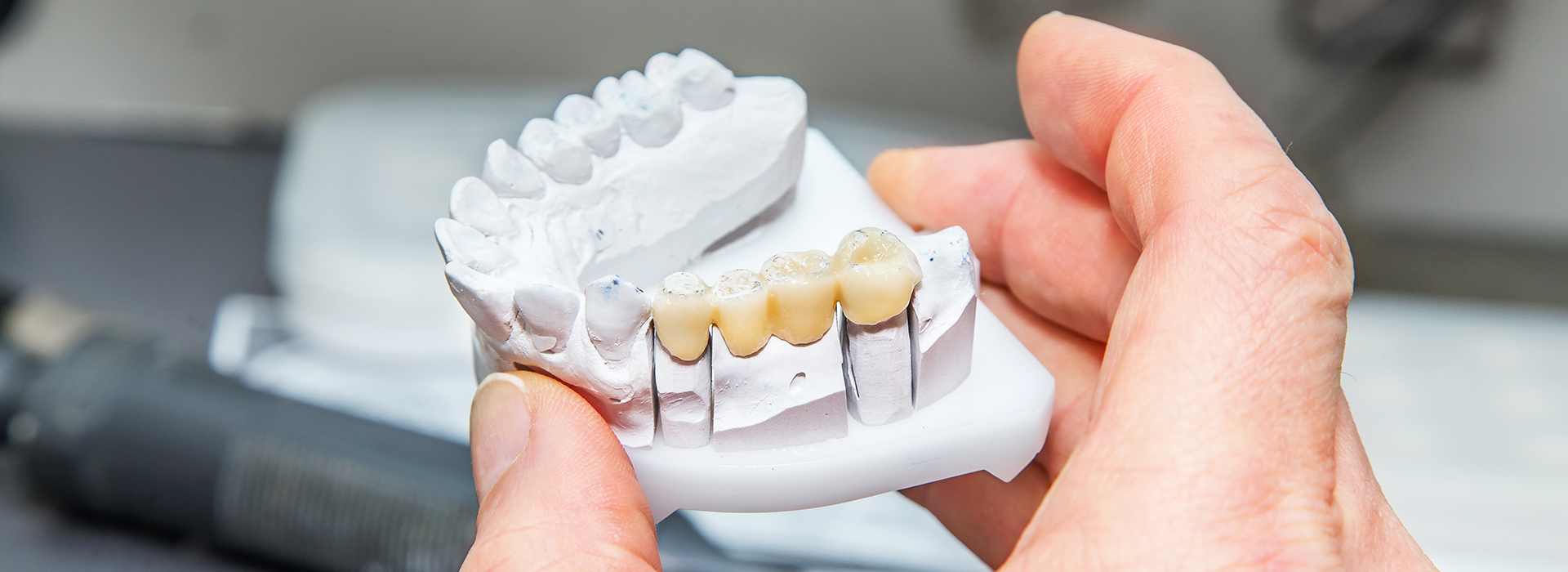 An individual holding a 3D printed model of a human mouth and teeth, showcasing the dental implant design.