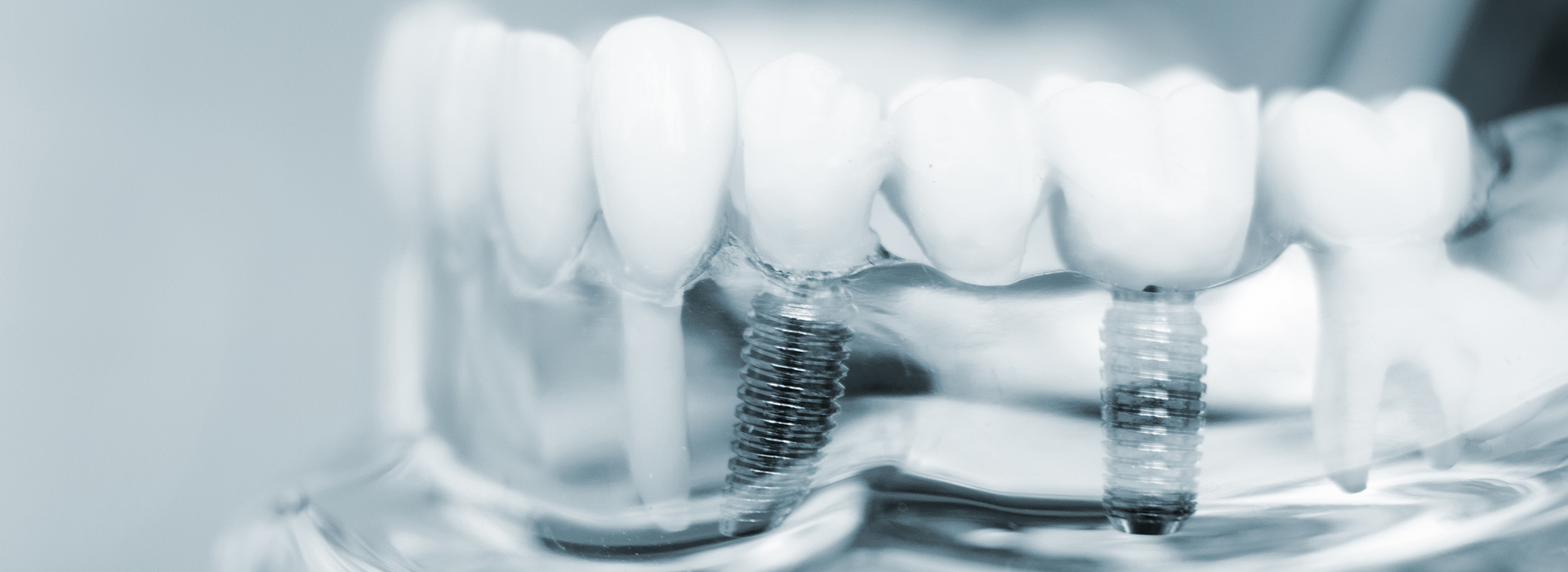 The image shows a close-up of several artificial teeth and a metal dental implant, which are part of a dental prosthetic.