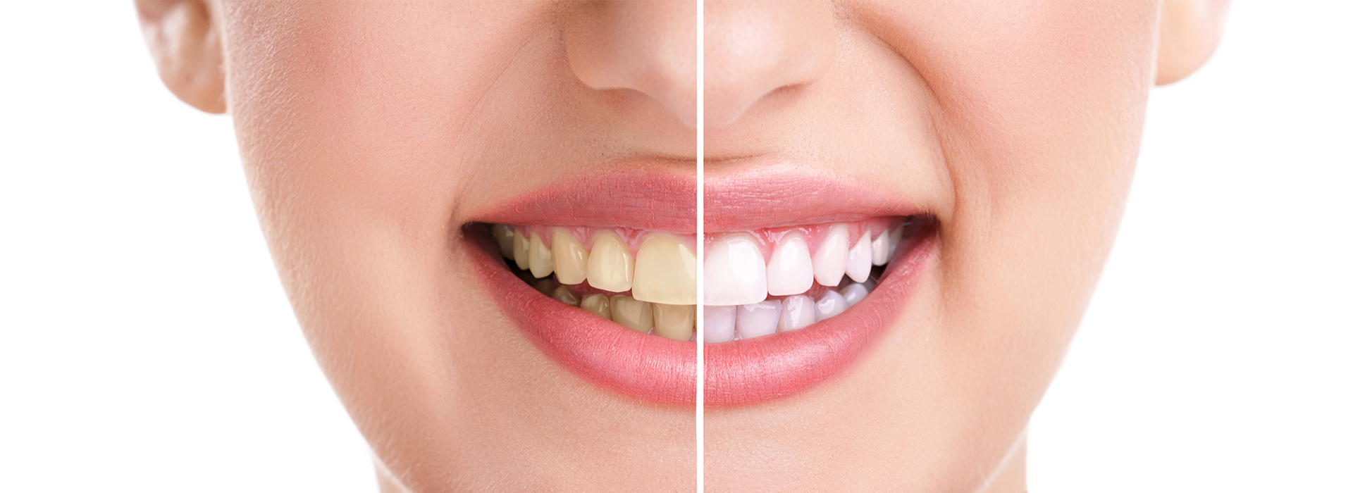 The image displays a close-up of a person s face with a smile, showcasing teeth whitening results.