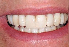 The image features a close-up of an individual s teeth, showcasing a bright and clean smile with a clear view of the upper front teeth.