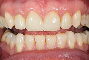 The image shows a close-up of a person s teeth with noticeable staining, particularly on the front teeth.
