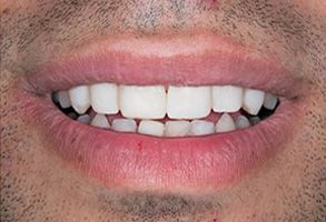 Image  A close-up of a person s smiling mouth with white teeth, showcasing a full set of dental implants.