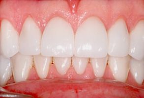 The image shows a close-up of a person s teeth with visible stains, likely for the purpose of dental care or cosmetic dentistry promotion.