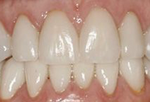 The image shows a close-up view of a person s teeth with an emphasis on the lower front teeth, which appear to be in need of repair or replacement due to discoloration and possible decay.