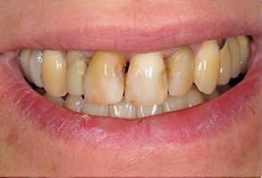 The image shows a person s teeth with yellow stains, some of which appear to be decaying or in need of dental care.