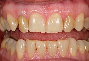 The image shows a close-up of a person s teeth, revealing a significant amount of dental work including crowns and bridges, with the teeth appearing yellowed.