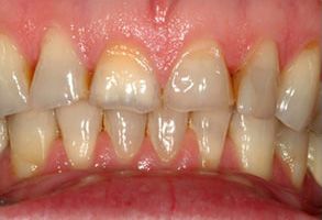 The image shows a close-up of a person s teeth with visible staining and yellowing, indicating the need for dental care or treatment.